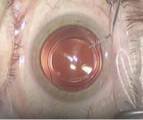 IOL refractive