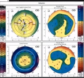 Astigmatism Management